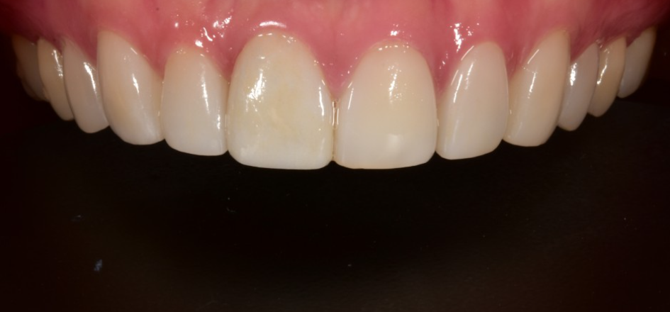 앞니 무삭제라미네이트 고객맞춤형 치아제작하는 블랙필름 관련 이미지 5