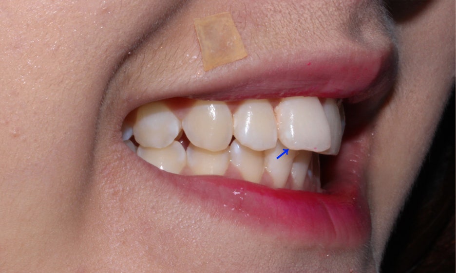 반포치과 뻐드렁니교정 방법은? 관련 이미지 3