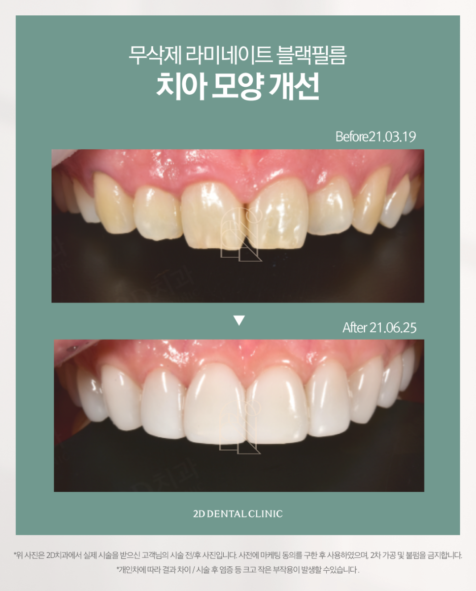 튼튼하면서도 자연스럽게, 치아무삭제라미네이트 앞니성형 관련 이미지 7