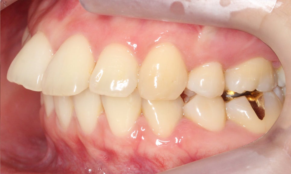 대치동치과 입툭튀 집어넣는 교정 관련 이미지 5