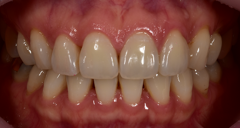 치아 블랙트라이앵글 원인, 예방, 치료 무삭제라미네이트 관련 이미지 7