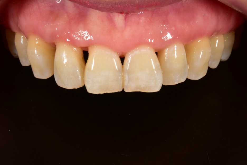 [투디치과] 블랙필름(비스포크) 치료의 다양한 사례 관련 이미지 8