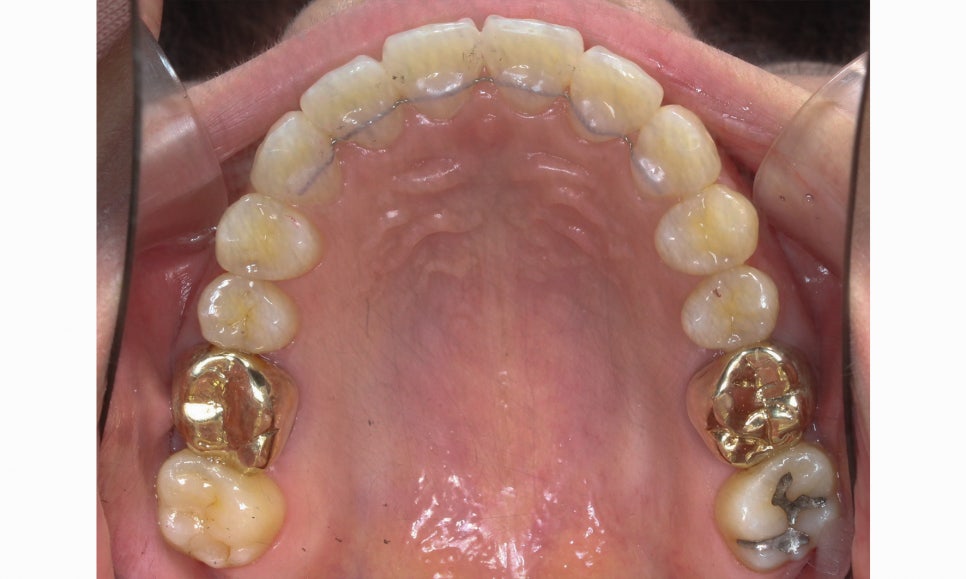 입툭튀 교정 신논현역치과 전체교정으로 관련 이미지 13