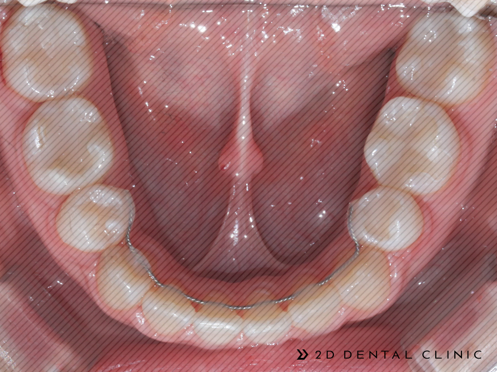 절단교합 교정 케이스 전후비교, 교정전문 2D치과 관련 이미지 11