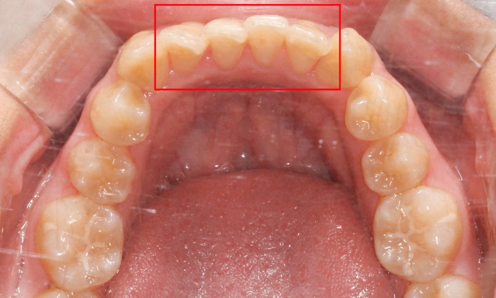 톱니모양 치아를 매끄러운 치아모양으로 개선하는 방법! (마멜론치아) 관련 이미지 5