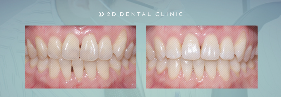 나비치아 교정 케이스 전후비교, 교정전문 2D치과 관련 이미지 1