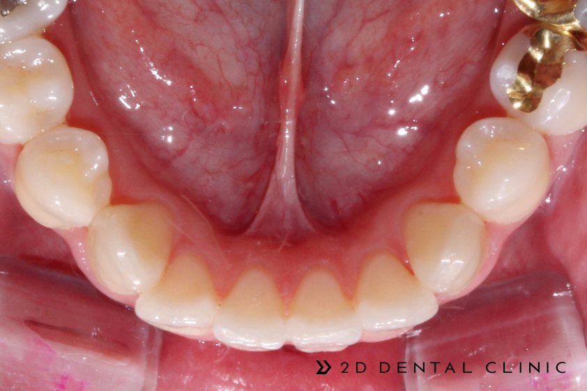 케이스로 확인하는 덧니 부정교합, 교정전문 2D치과 관련 이미지 8