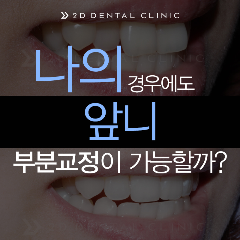 앞니 부분교정, 나의 경우에도 가능할까? 전후 사진 비교 관련 이미지 2