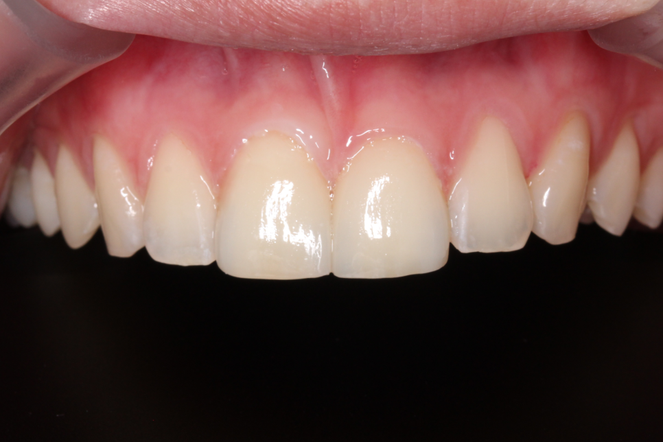 [투디치과] 블랙필름(비스포크) 치료의 다양한 사례 관련 이미지 32