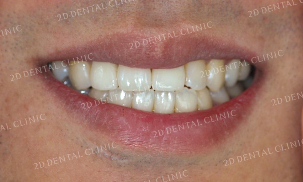 치아변색, 까맣게 변한 변색치를 블링스(Blinx)로 수복하기! by. 투디치과(2D치과) 관련 이미지 7