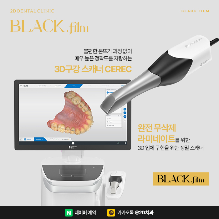 아랫니 라미네이트 가장 중요한 포인트는 삭제량, 완전 무삭제라미네이트 블랙필름 관련 이미지 4