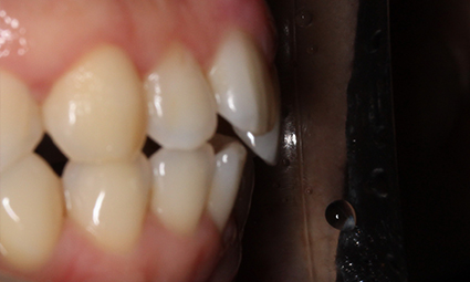 앞니틀어짐 부분교정 완성 후기 관련 이미지 3