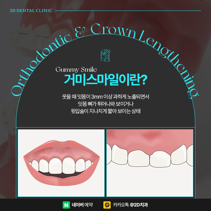 거미스마일 개선을 위한 치아교정, 강남 잇몸성형 관련 이미지 2