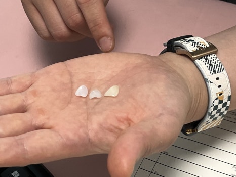 무삭제 라미네이트 부작용이 걱정된다면 치아 다듬거나 삭제 일절 없는 블랙필름 관련 이미지 4