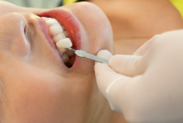 치아변색 고민없는 무삭제라미네이트 블랙필름 관련 이미지 5