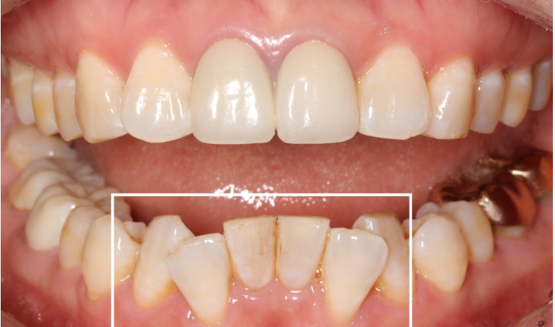 치아교정과 무삭제라미네이트 블랙필름 나에게 맞는 시술찾기 관련 이미지 3