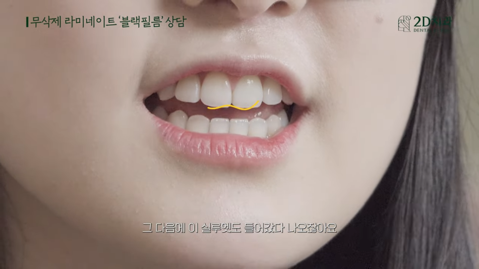 [블랙필름 상담받고 왔어요] #1 큰 앞니 작게 만들 수 있나요? 관련 이미지 17