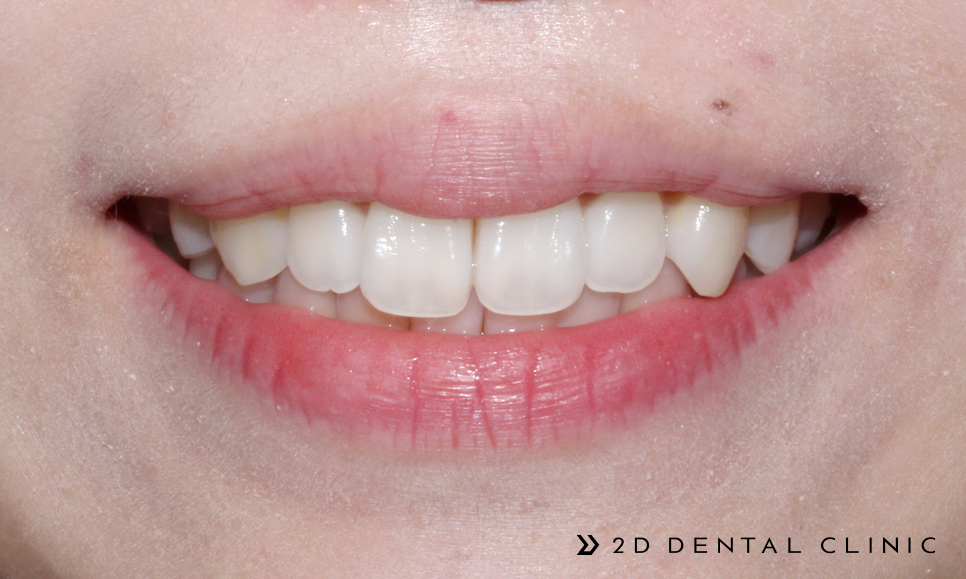 케이스로 확인하는 토끼이빨, 교정전문 2D치과 관련 이미지 4