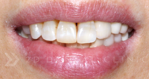 블랙트라이앵글 치아사이틈 개선은 무삭제라미네이트 블랙필름 관련 이미지 3