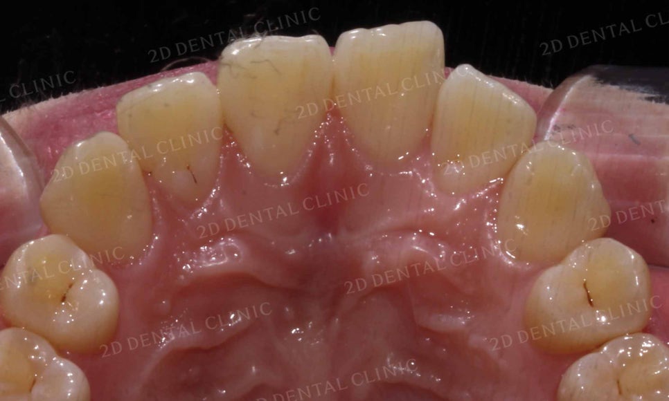 강남역 치과에서 앞니부분 설측 2D(투디)교정으로 토끼앞니 탈출한 후기 관련 이미지 16