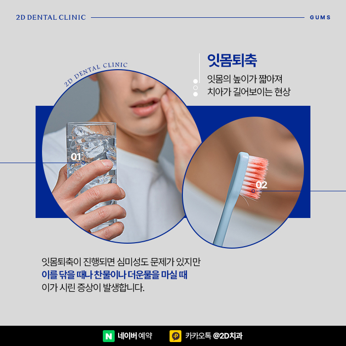 치아관리만큼 중요한 잇몸관리, 잇몸염증, 잇몸퇴축 예방하는 방법, 신논현 잇몸성형 관련 이미지 4