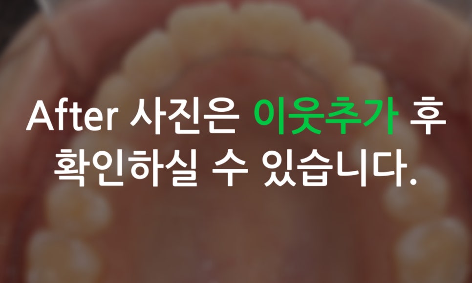 세라믹교정 앞니틀어짐 교정 사례 관련 이미지 9
