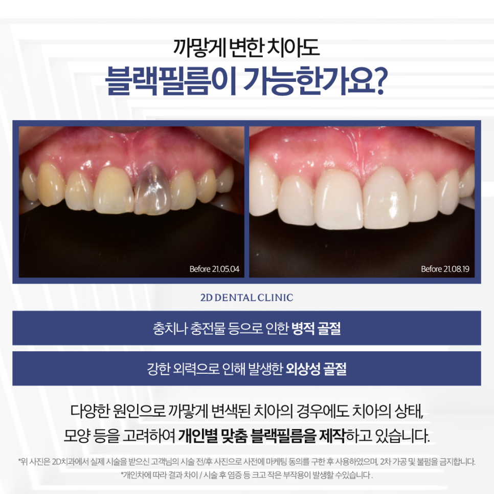 부산무삭제라미네이트 앞니치아변색 까만 이도 회복할 수 있을까? 관련 이미지 5