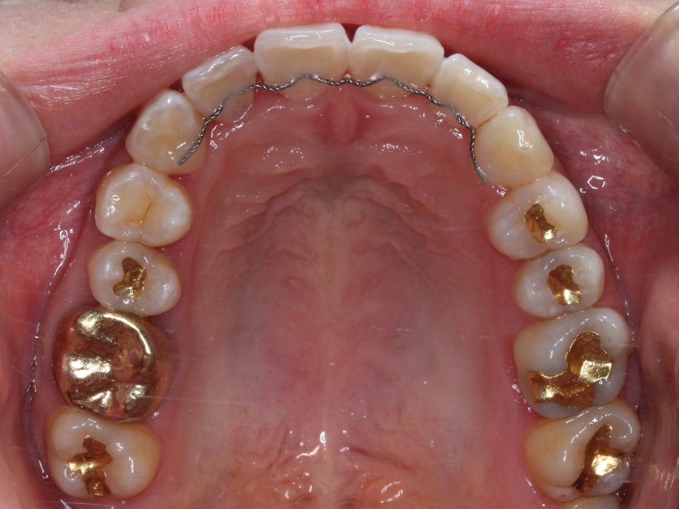 덧니 투명교정 8개월 치료 사례 관련 이미지 13