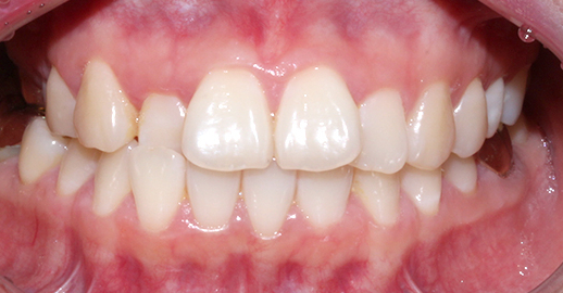 2D치과 2D교정으로 4개월만에 덧니 개선! 관련 이미지 4