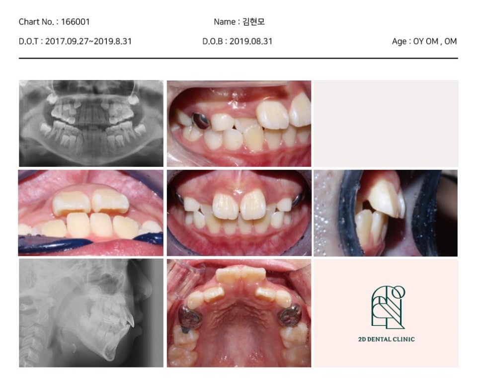 어린이 반대교합 덧니 교정으로 교정 끝! by. 투디치과(2D치과) 관련 이미지 2