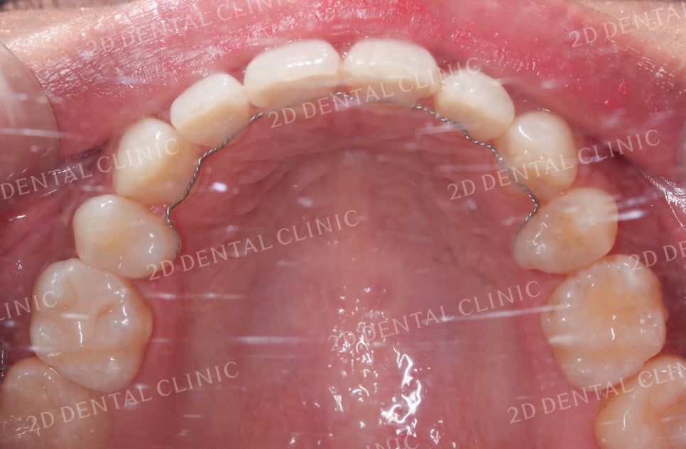 비대칭 앞니, 돌출앞니를 전체 교정으로 교정하고 싶다면!? by.투디치과(2D치과) 관련 이미지 14