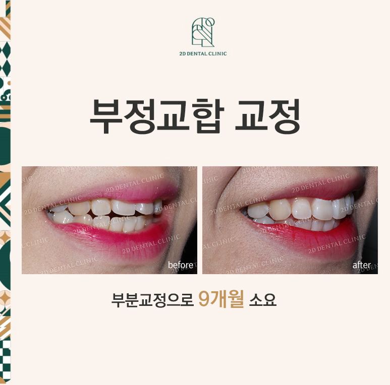 [앞니교정] 부정교합 교정, 앞니교정으로 부정교합 교정하는 방법! by. 투디치과(2D치과) 관련 이미지 1