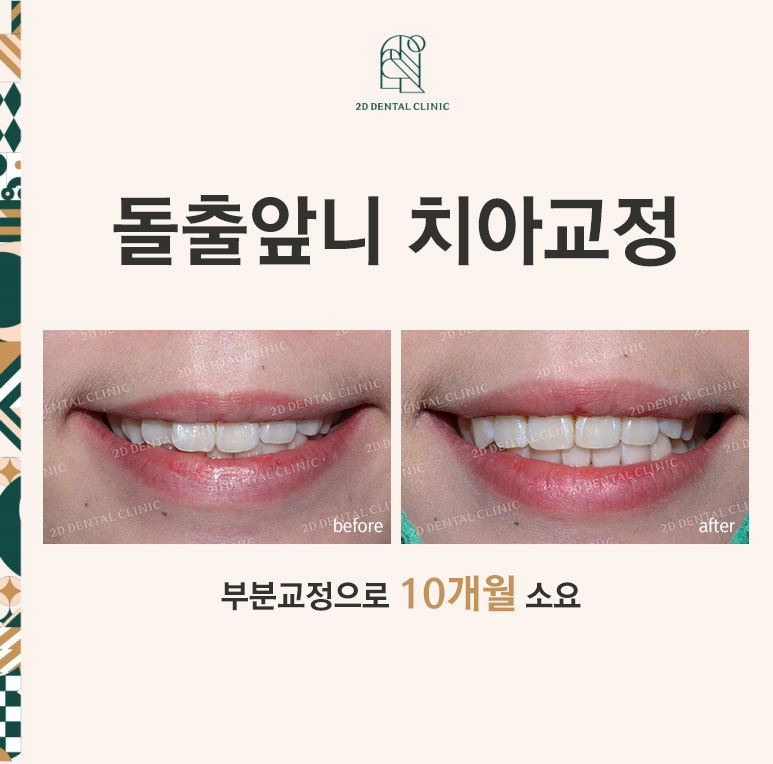 돌출입, 돌출앞니를 부분교정으로 고르게! by.투디치과(2D치과) 관련 이미지 1