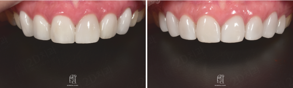 무삭제블랙필름 실제 후기 관련 이미지 15