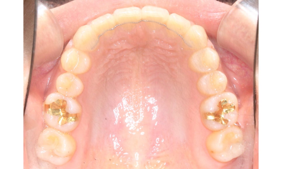 나비앞니 세라믹교정 case 관련 이미지 13