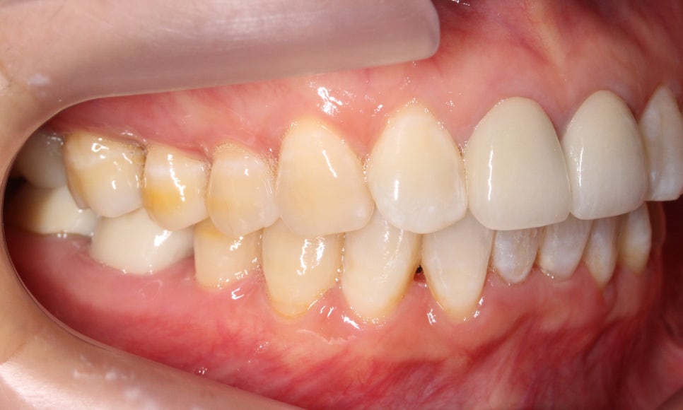2D교정으로 아랫니 부분교정 빠르게 완성하기! 관련 이미지 8