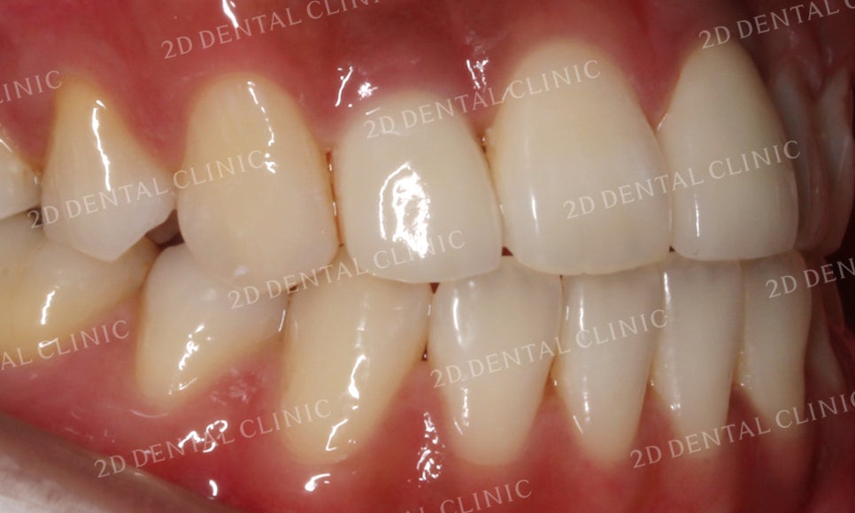 치아변색, 까맣게 변한 변색치를 블링스(Blinx)로 수복하기! by. 투디치과(2D치과) 관련 이미지 15