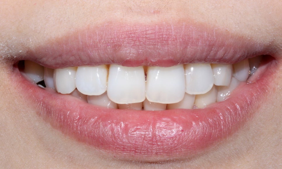 토끼 이빨 치아교정 5개월 교정 완료! by. 투디치과(2D치과) 관련 이미지 4