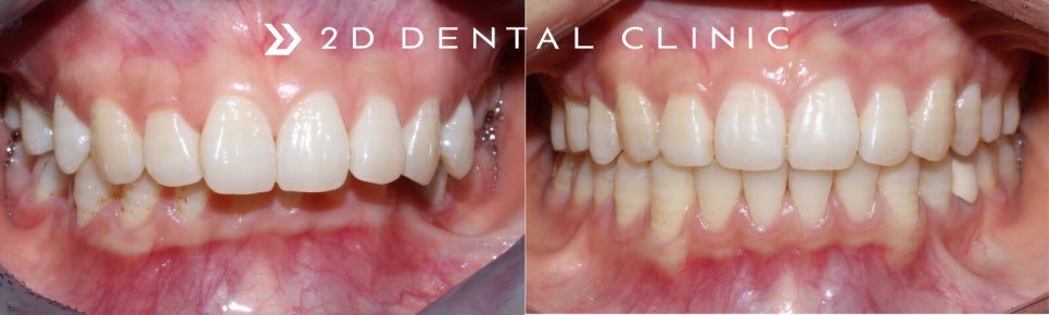 [2D치과]과개교합(Deep bite)이란? 관련 이미지 1