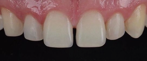 앞니충치 무삭제라미네이트비용 블랙필름 관련 이미지 2