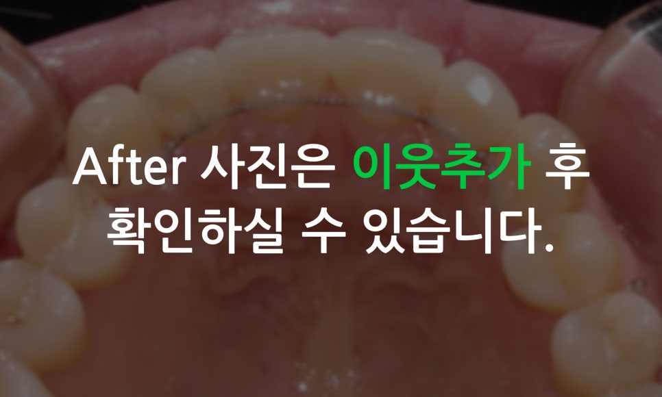 앞니틀어짐 2D교정으로 한번에 끝내는 방법! 관련 이미지 7