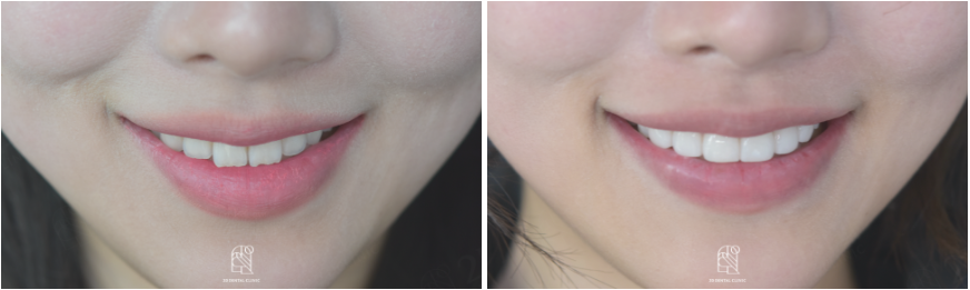 치아라미네이트 잘 하는 투디치과 관련 이미지 16