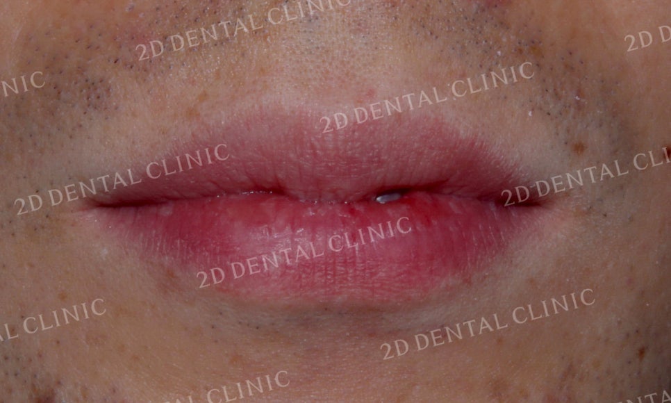 [투디교정] 부정교합 앞니교정을 투디교정으로 고르게! by.투디치과(2D치과) 관련 이미지 2