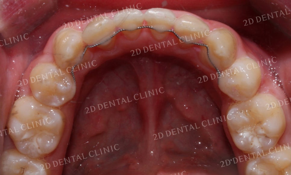 돌출앞니 교정, 튀어나온 입을 넣어보자! by.투디치과(2D치과) 관련 이미지 29