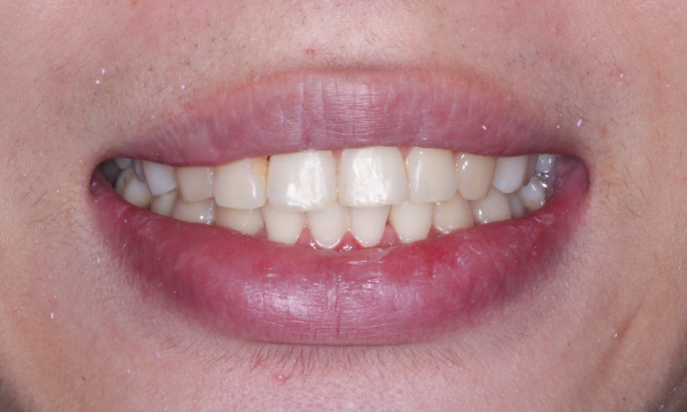 나비치아교정! 15개월만에 빠른 교정 by.투디치과(2D치과) 관련 이미지 11