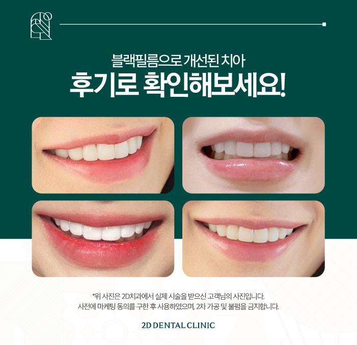 무삭제라미네이트 진행 과정이 궁금하신가요? 관련 이미지 7