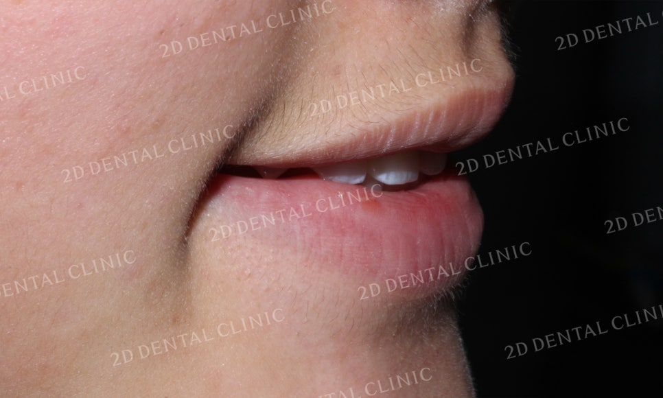 반대교합 치아교정, 앞니를 가지런하게! by.투디치과(2D치과) 관련 이미지 12