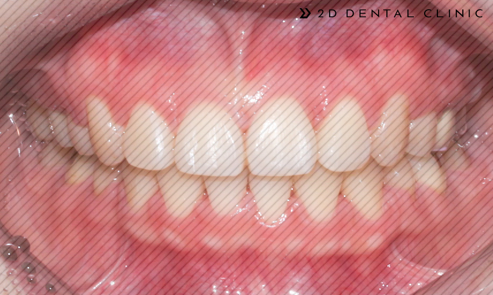 발치교정 돌출입 케이스, 교정전문 2D치과 관련 이미지 8