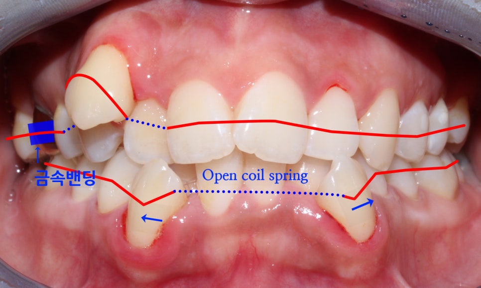crowding 송곳니덧니 세라믹교정 방법 관련 이미지 2