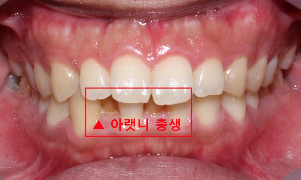 뻐드렁니 교정, 강남역치과에서 앞니 부분 교정한 후기! 관련 이미지 5